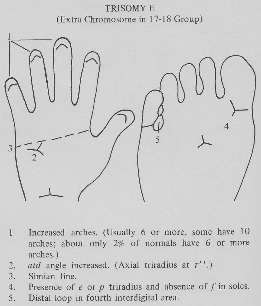 3 Hand Charts For Edwards Syndrome Trisomy 18