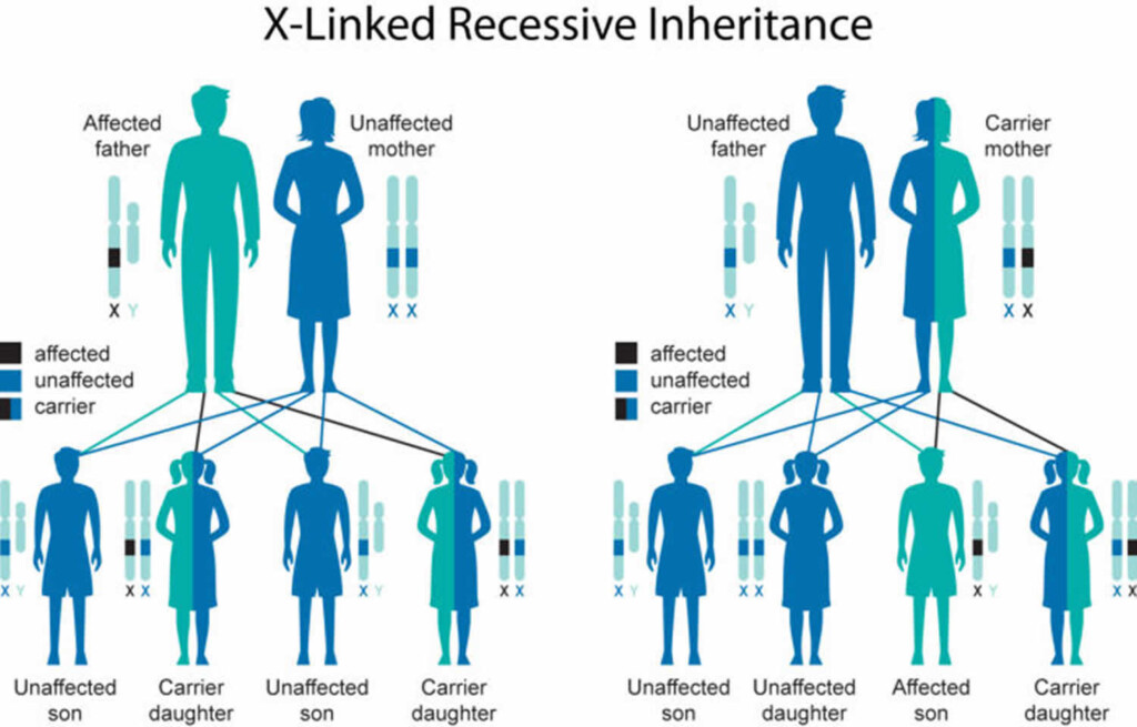 Duchenne Muscular Dystrophy Causes Symptoms Diagnosis Treatment 