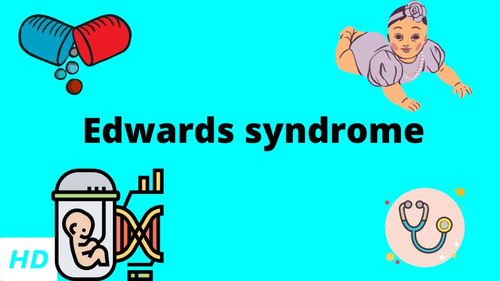 Edwards Syndrome trisomy 18 Causes Symptoms And Types 40 OFF