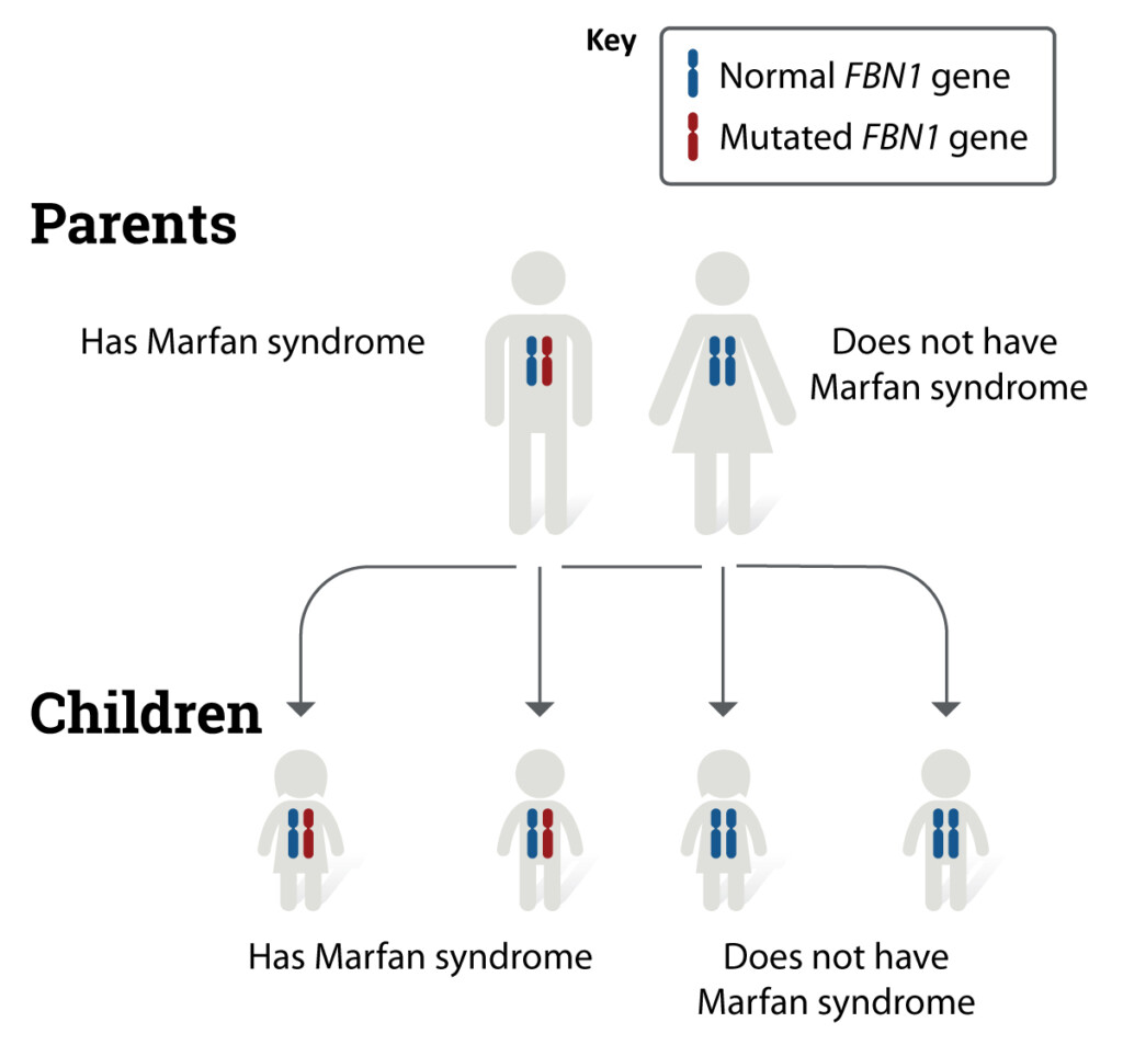 Marfan Syndrome Causes NHLBI NIH